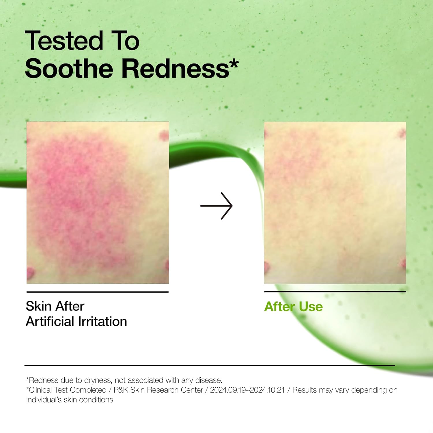 ANUA Azelaic Acid 10 Hyaluron Redness Soothing Serum – 30ml - Umma Bear Shop